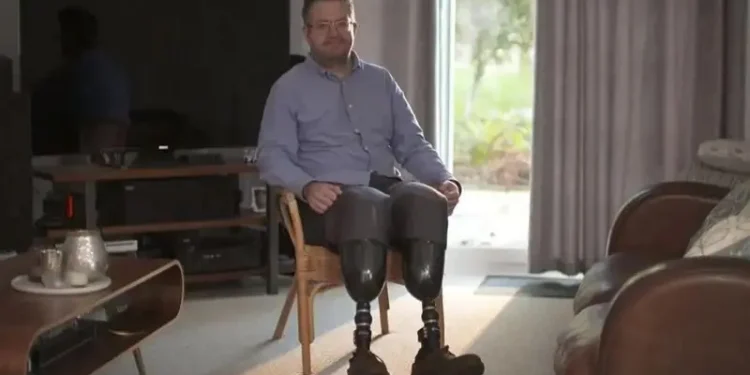 U Bwongereza: Umuganga yikase amaguru ngo abone amafaranga none byamukozeho